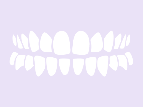 Dlanqueamiento dental con luz ultravioleta y con láser